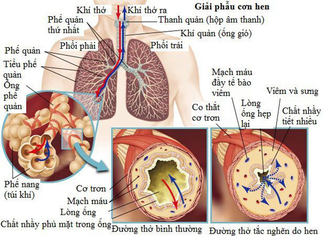 bệnh lý hen